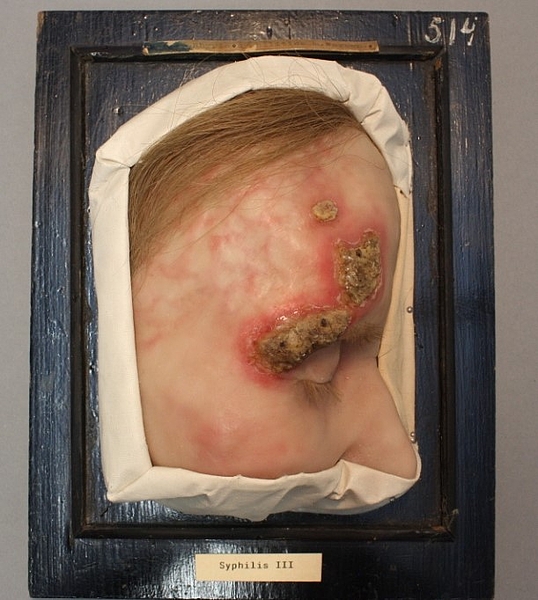 schwarzer Bilderrahmen mit einem Modell von einer Hautkrankheit, hautklinik rostock