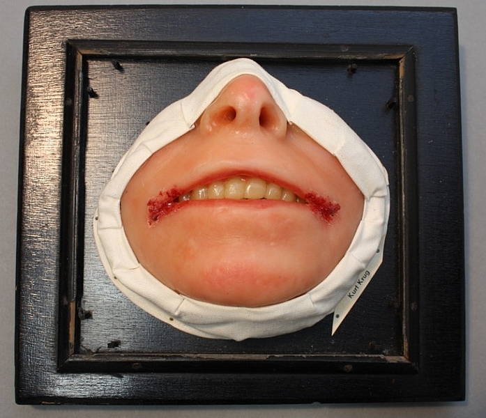 Schwarzer Bilderrahmen mit Modell von einem Mund mit Hautkrankheit, hautklinik Rostock