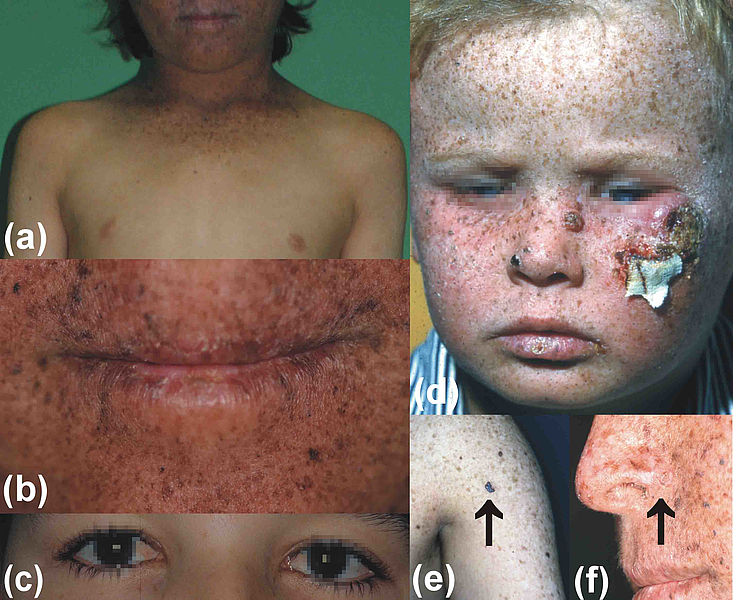 Fotocollage mit Bildern einer Hautkrankheit, Hautklinik rostock