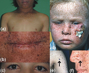 Klinische Symptome von Xeroderma pigmentosum