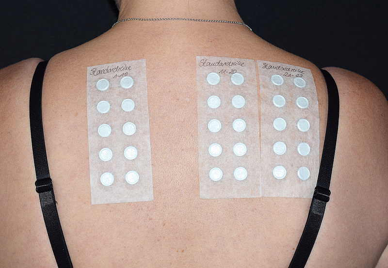 Nackter Rücken mit Allergiepflastern, allergologe rostock